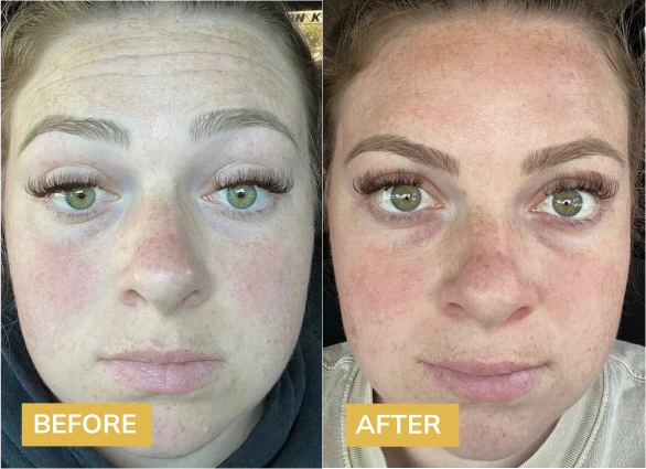 Botox Before & After Banner