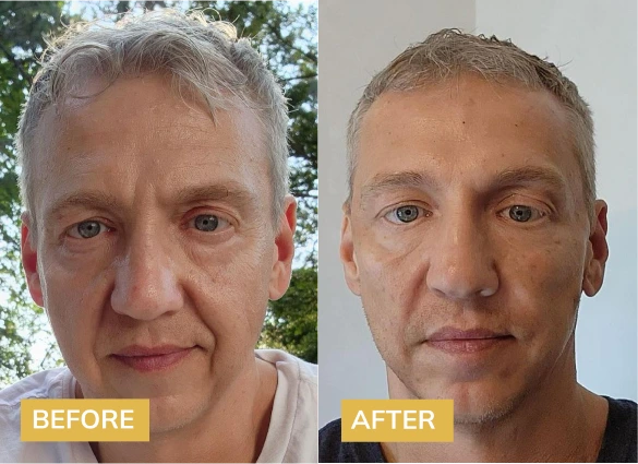 Botox Before & After Banner