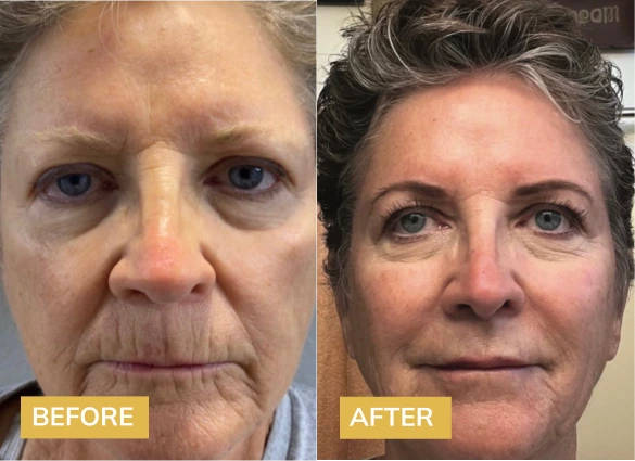 Botox Before & After Banner