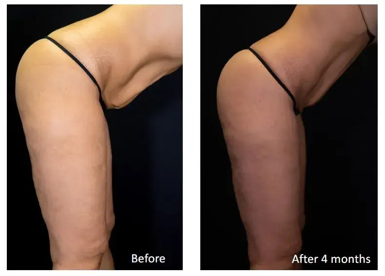 body contouring