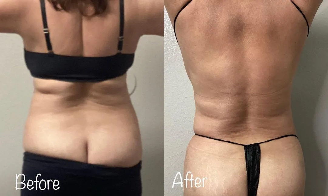 liposuction