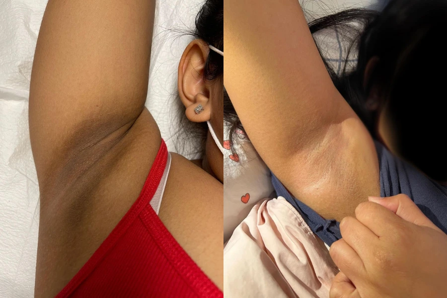 skin lightning with Aerolase laser treatments and skin lightening kit