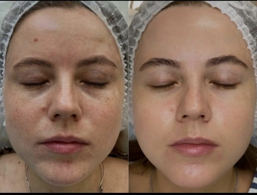 chemical peel skin rejuvenation