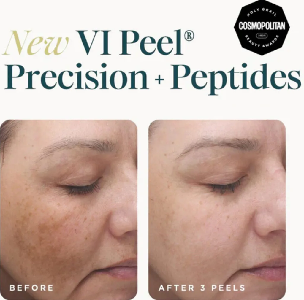 chemical peel skin rejuvenation