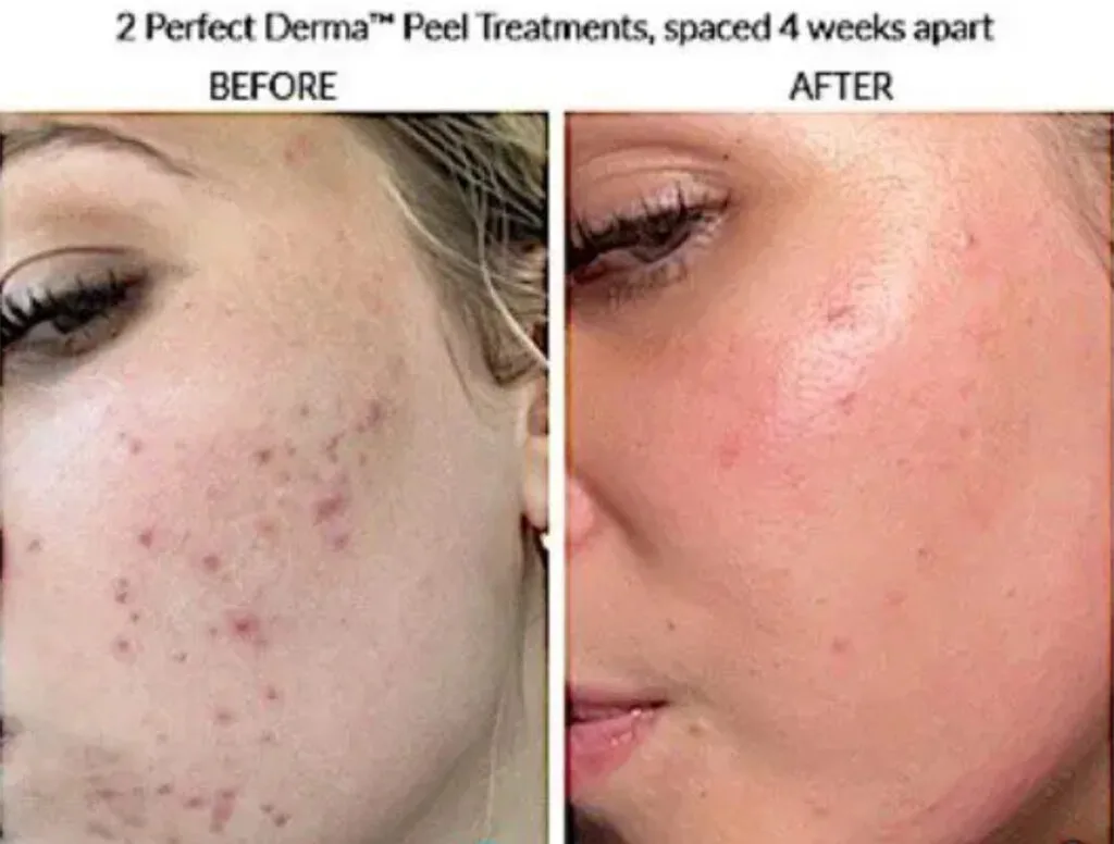 skin rejuvenation
